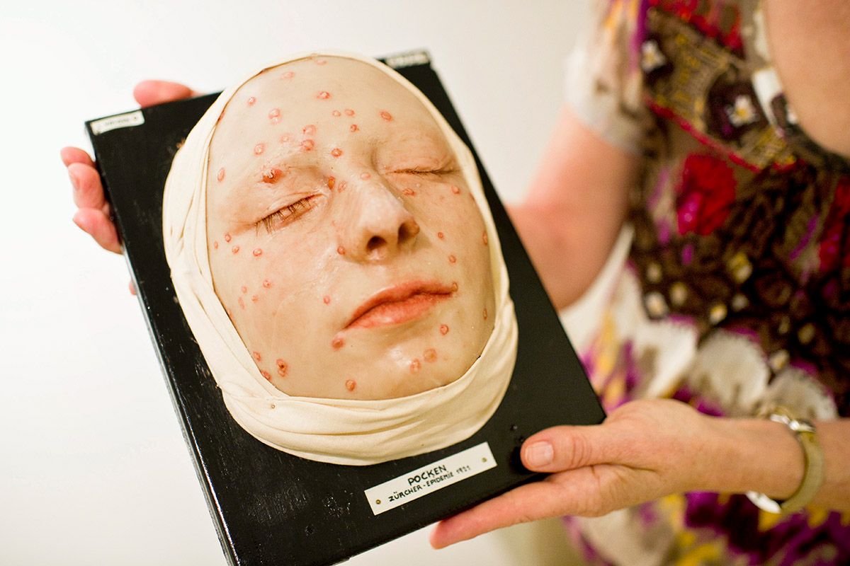 Ein mit Pocken befallenes Gesicht (Modell) in der Ausstellung «Zeit für Medizin» im Mai 2011 im Historischen Museum in St. Gallen. Foto: Keystone-SDA / Ennio Leanza. Ein mit Pocken befallenes Gesicht (Modell) in der Ausstellung «Zeit für Medizin» im Mai 2011 im Historischen Museum in St. Gallen. Foto: Keystone-SDA / Ennio Leanza.